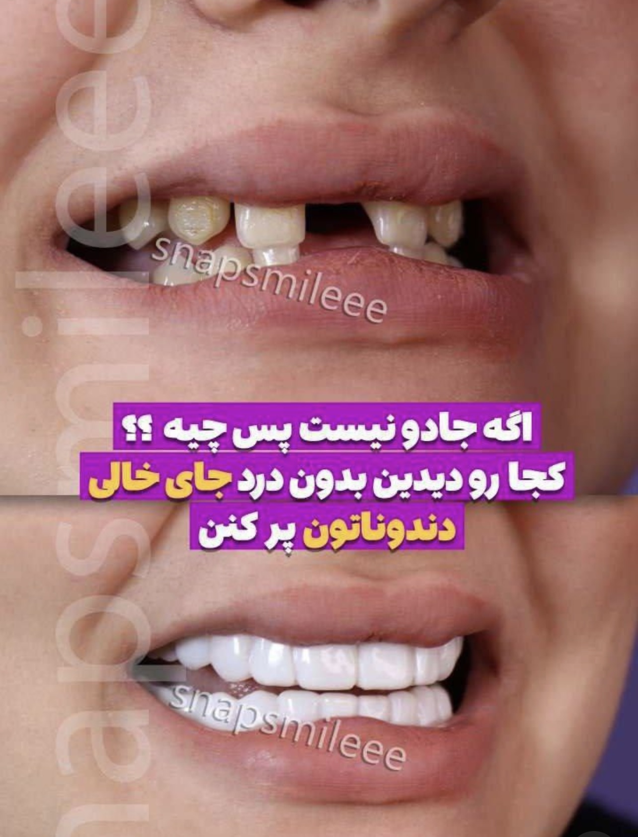 روکش دندان دو فک اسنپ اسمایل ایرانی به همراه جایزه 200 تومانی